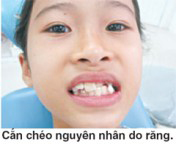nguyen-nhan-can-cheo-rang-truoc-tre-em-01 nguyen-nhan-can-cheo-rang-truoc-tre-em-01