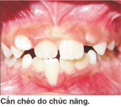 nguyen-nhan-can-cheo-rang-truoc-tre-em-02 nguyen-nhan-can-cheo-rang-truoc-tre-em-02